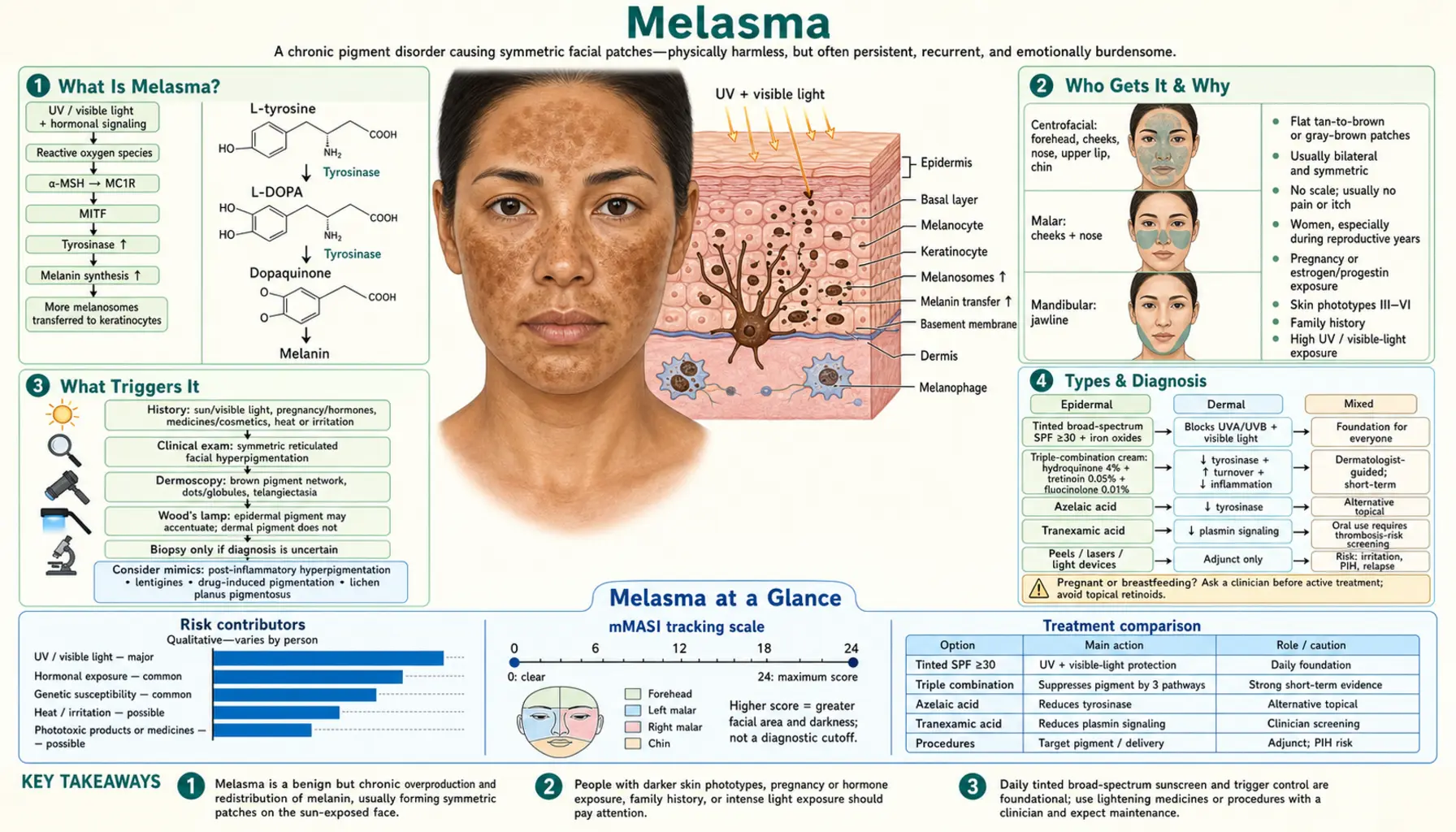 Melasma — scientific infographic poster