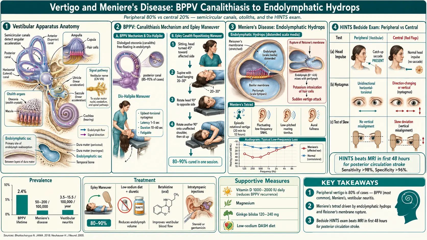 Vertigo and Meniere's Disease — scientific infographic poster