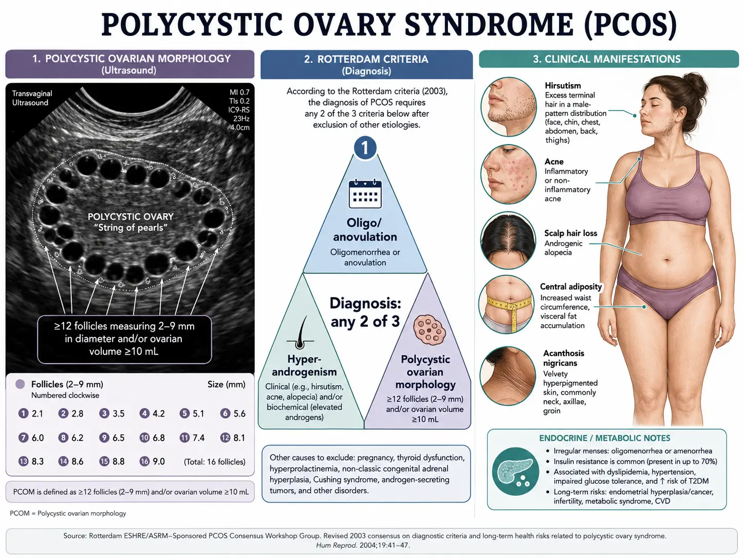PCOS string-of-pearls ovary, Rotterdam criteria triangle, hyperandrogenism manifestations