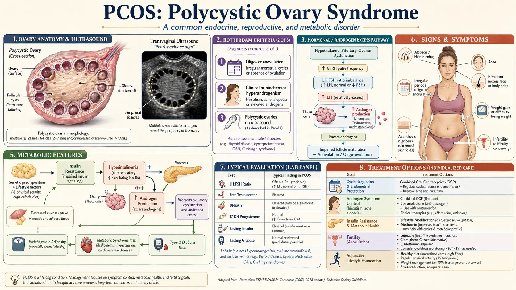 PCOS — scientific infographic poster