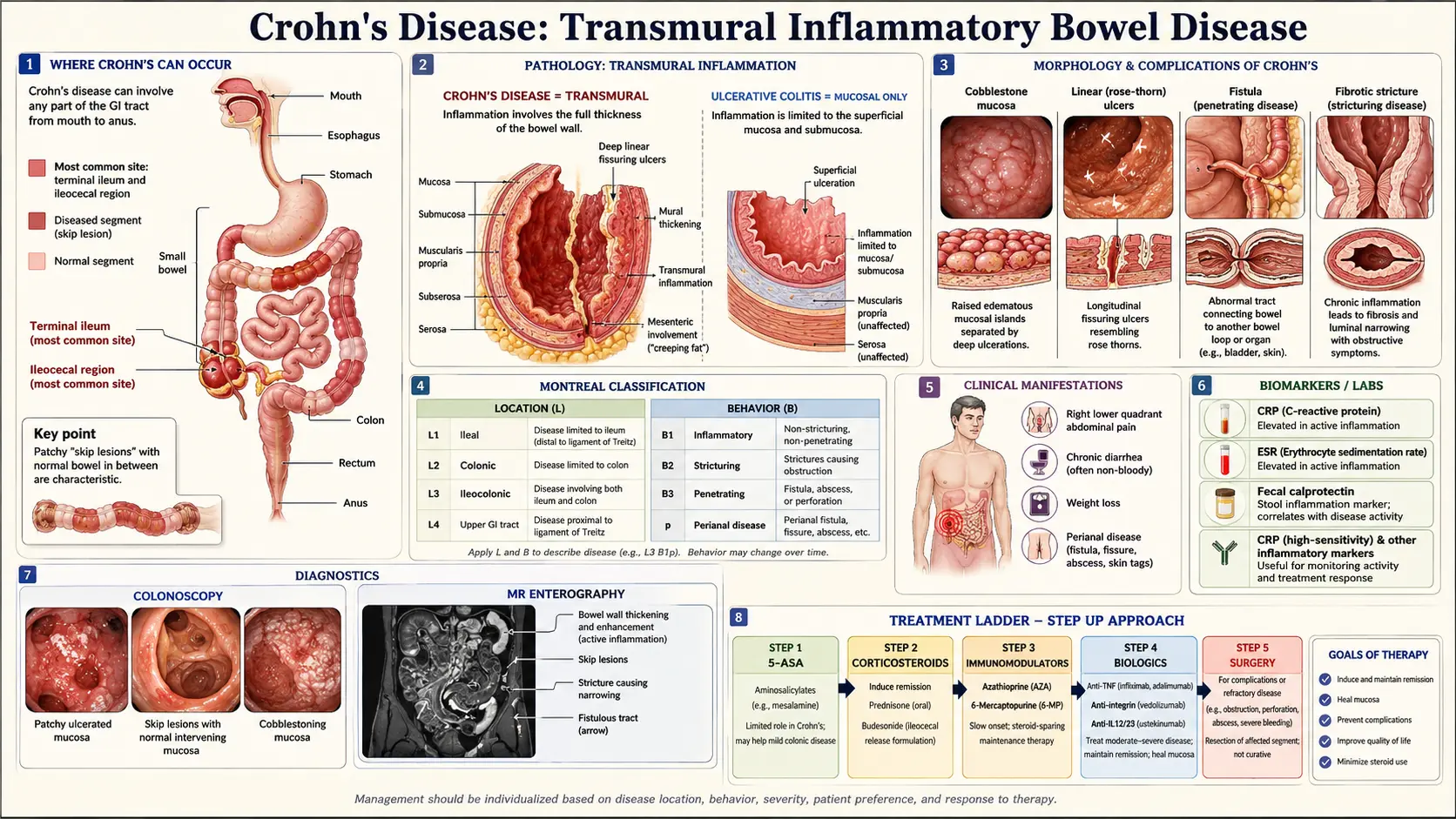 Crohns Disease — scientific infographic poster