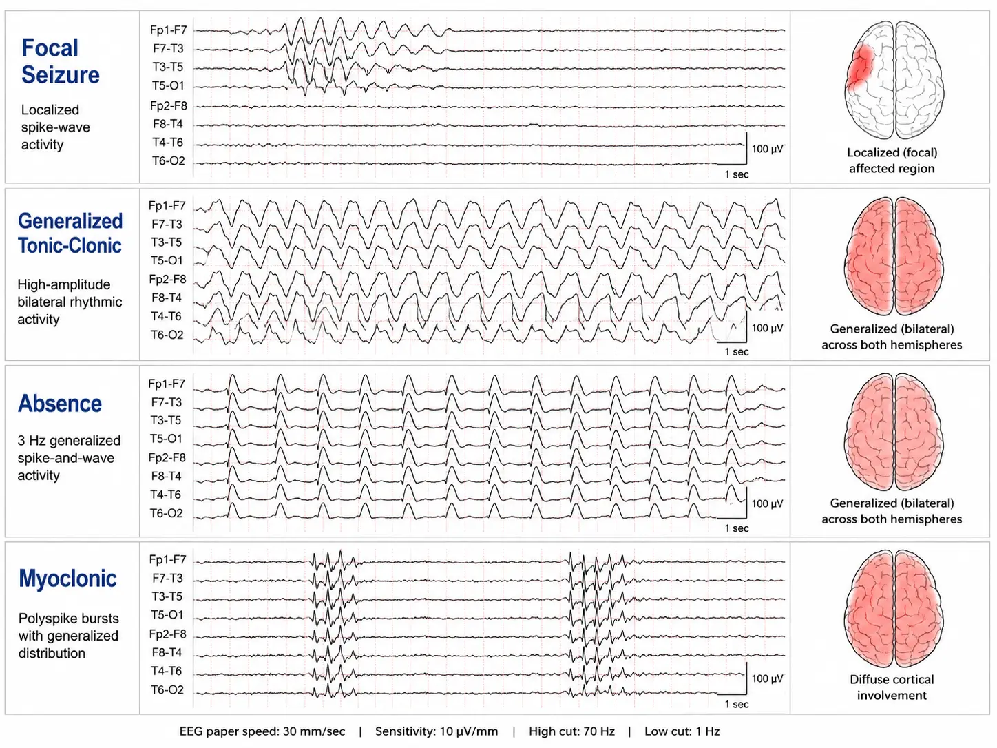 Seizure types EEG comparison