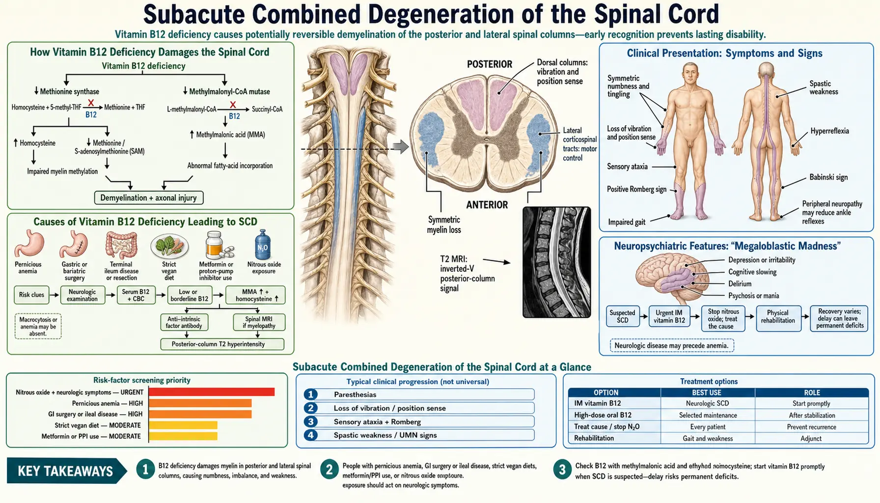 Subacute Combined Degeneration — scientific infographic poster