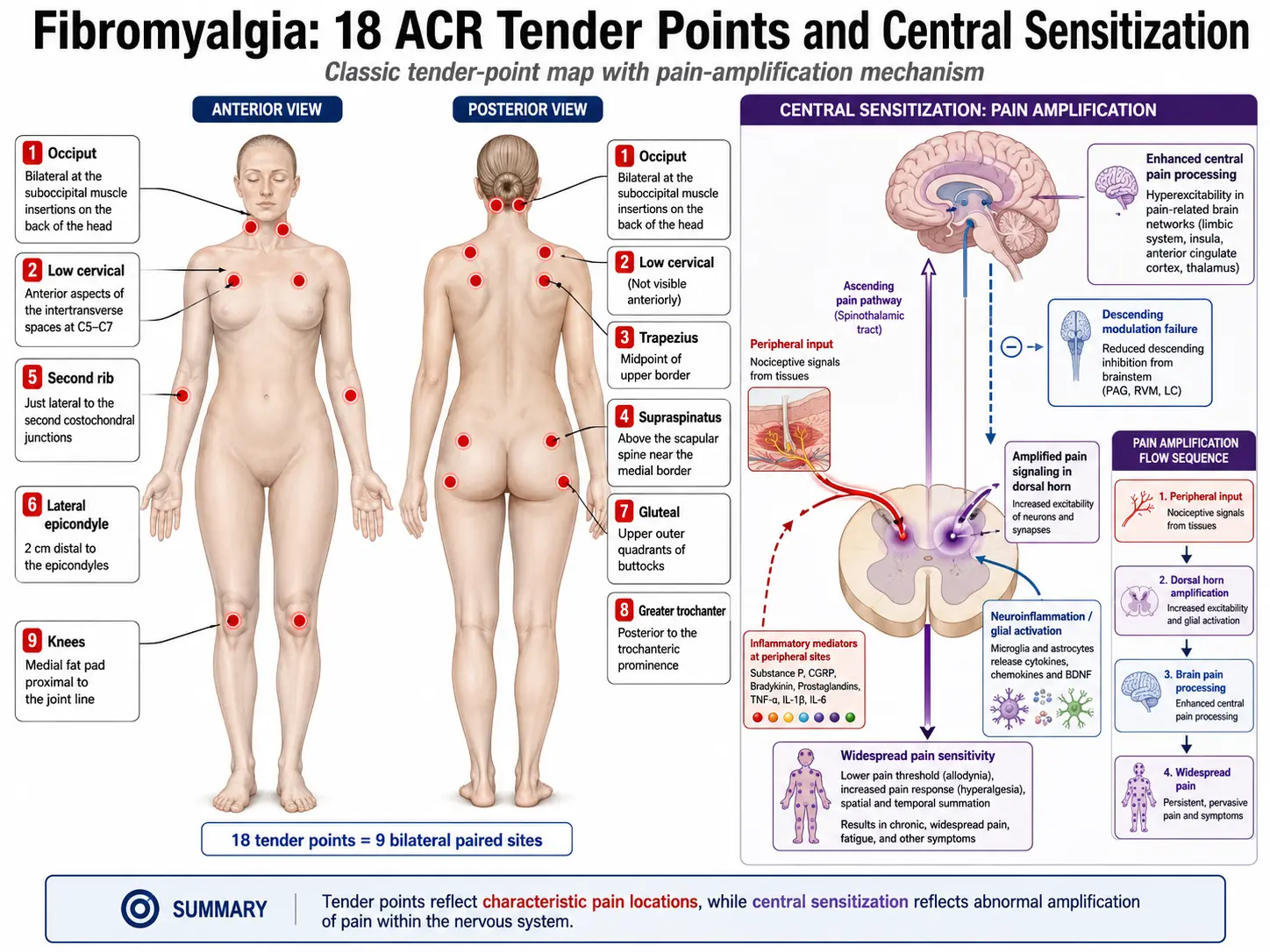 Diagram of the 18 tender points used in the historical 1990 ACR fibromyalgia criteria