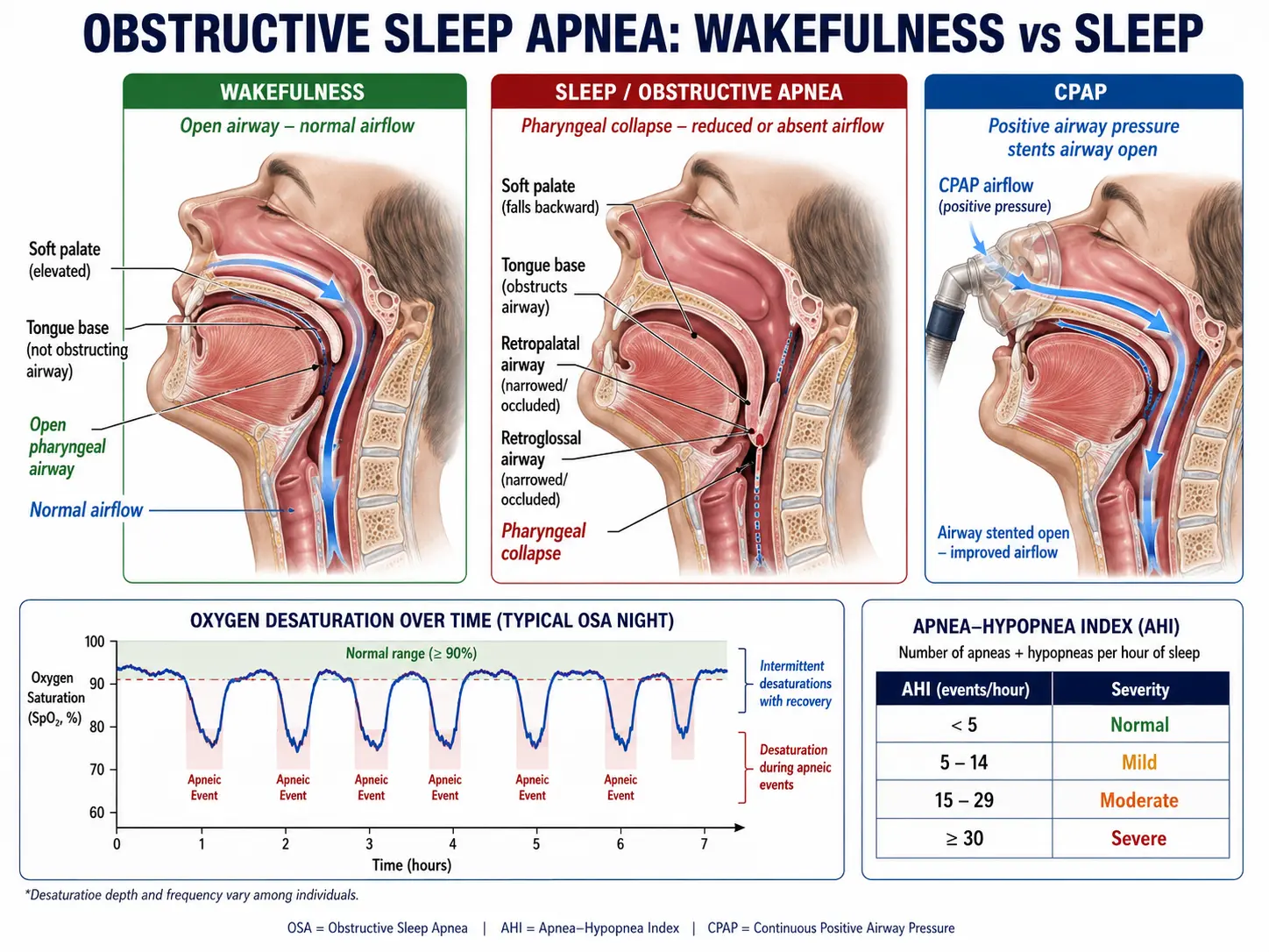 OSA airway collapse